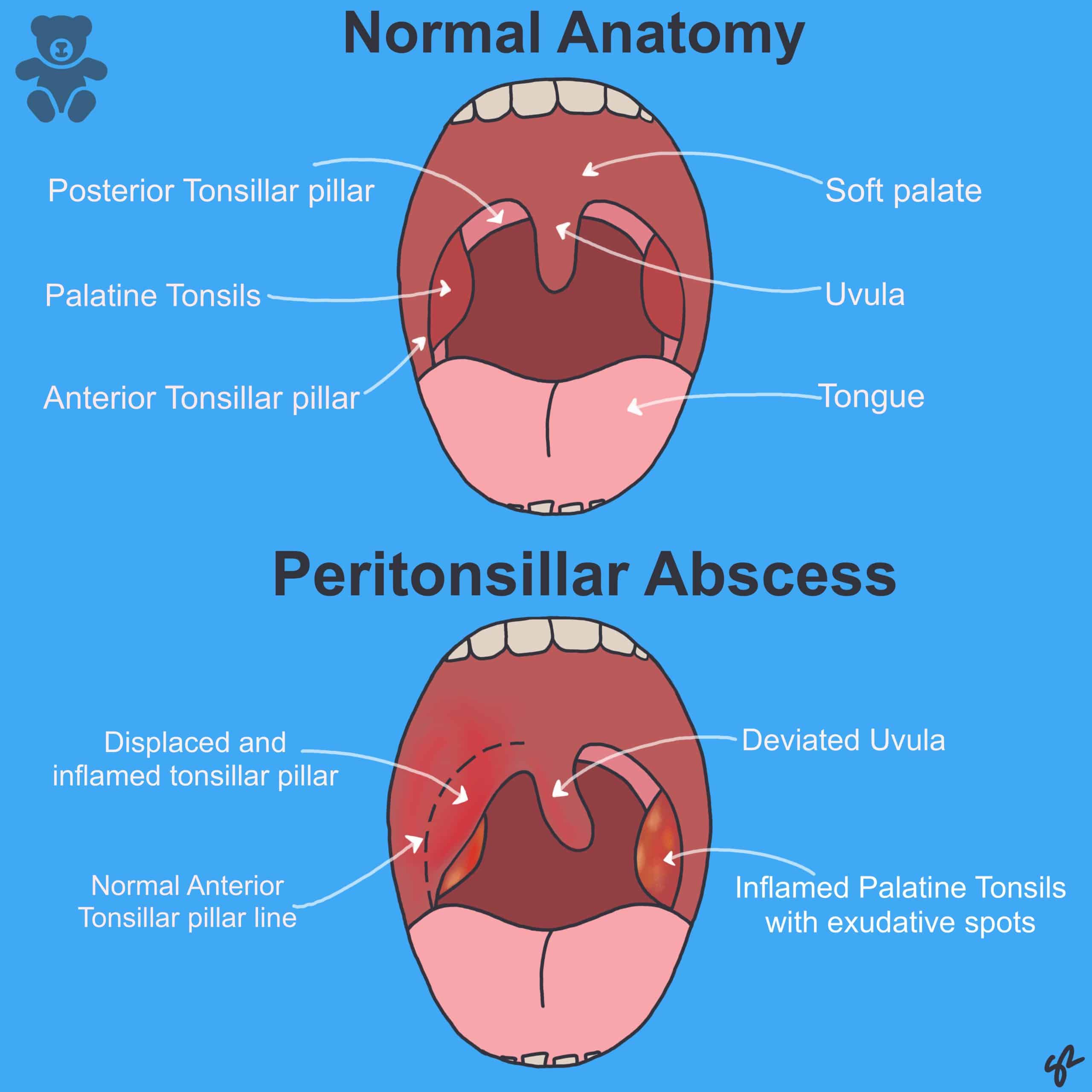 Abscess Tooth Removal