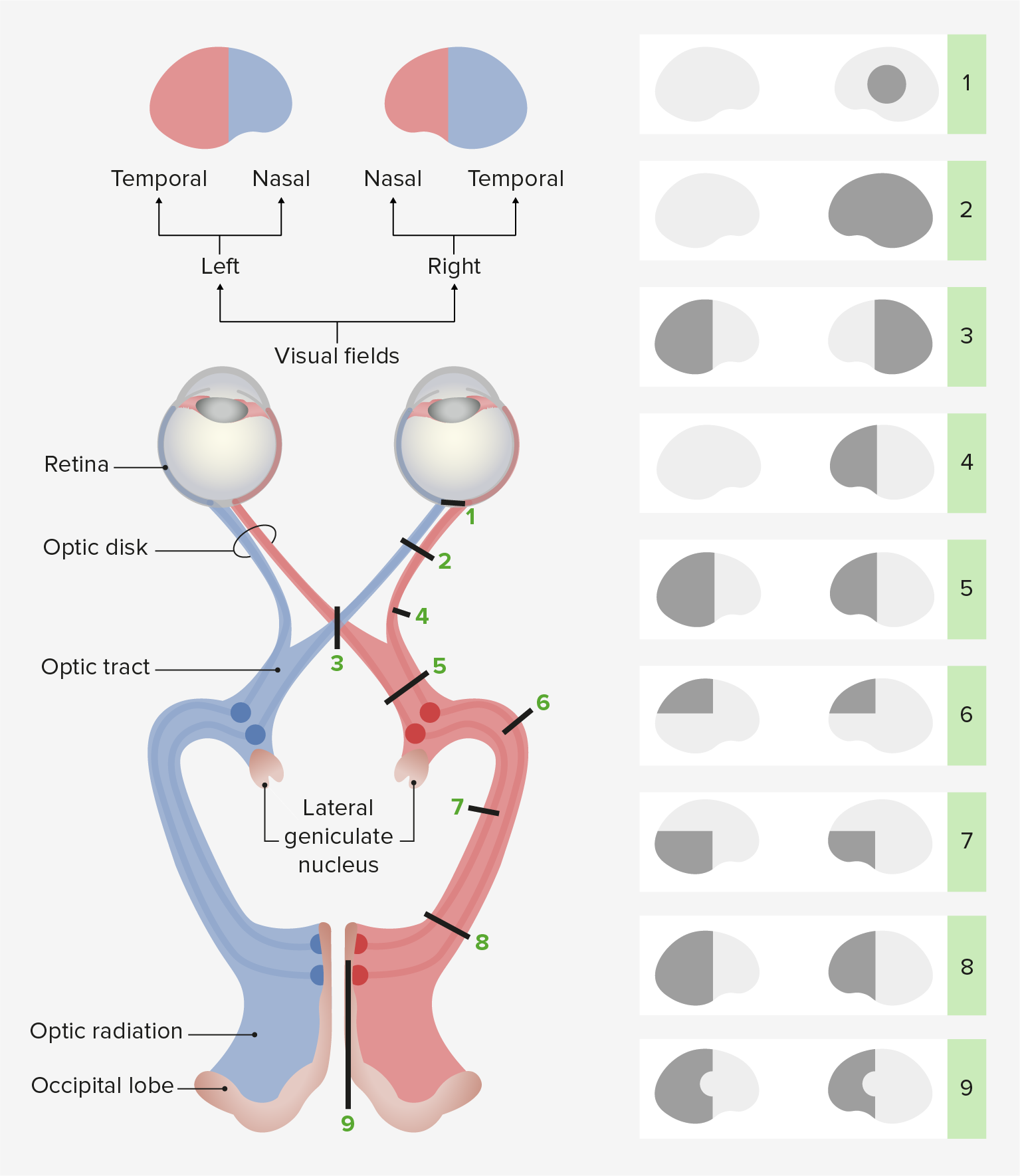 Afferent Loop Syndrome