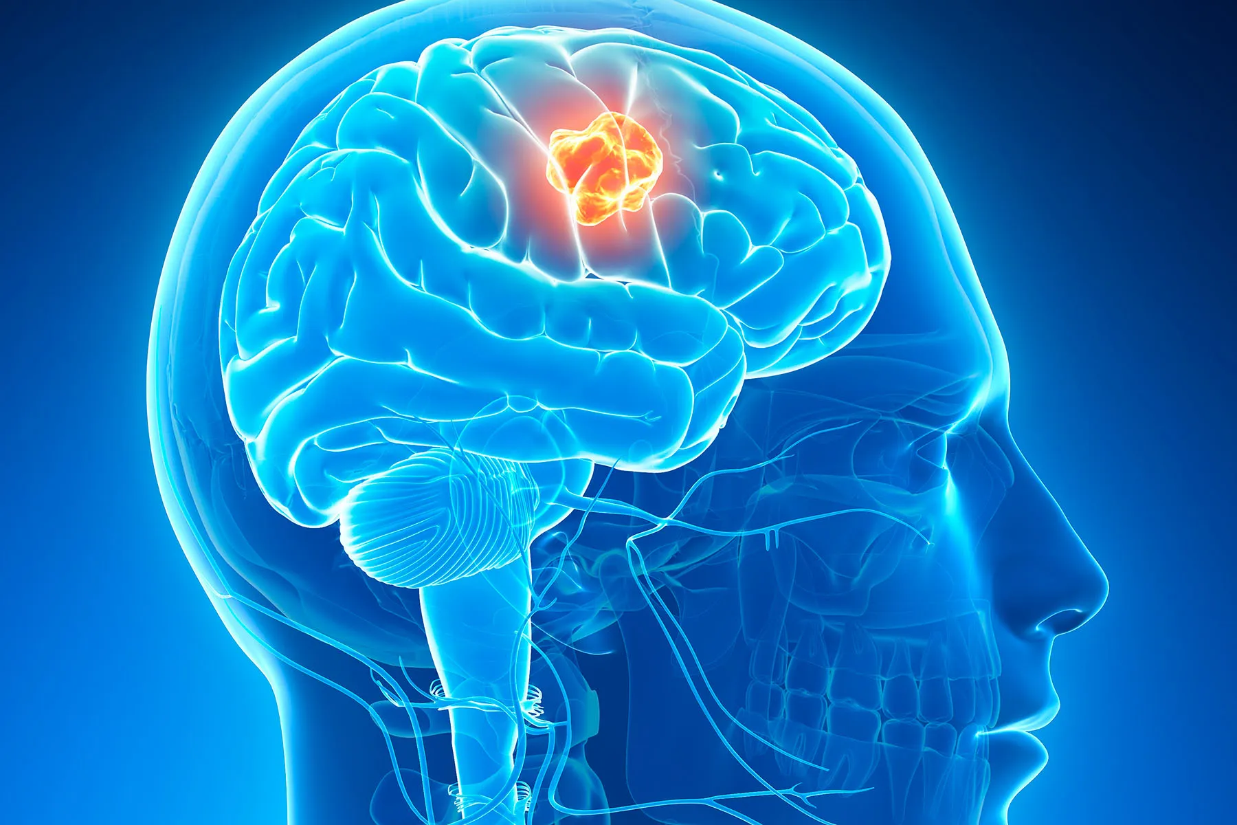 Aggressive Behavior And Brain Tumor Causes Explained