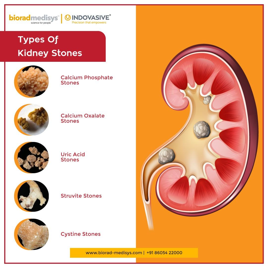 The Ultimate Guide To Understanding All About Kidney Stones