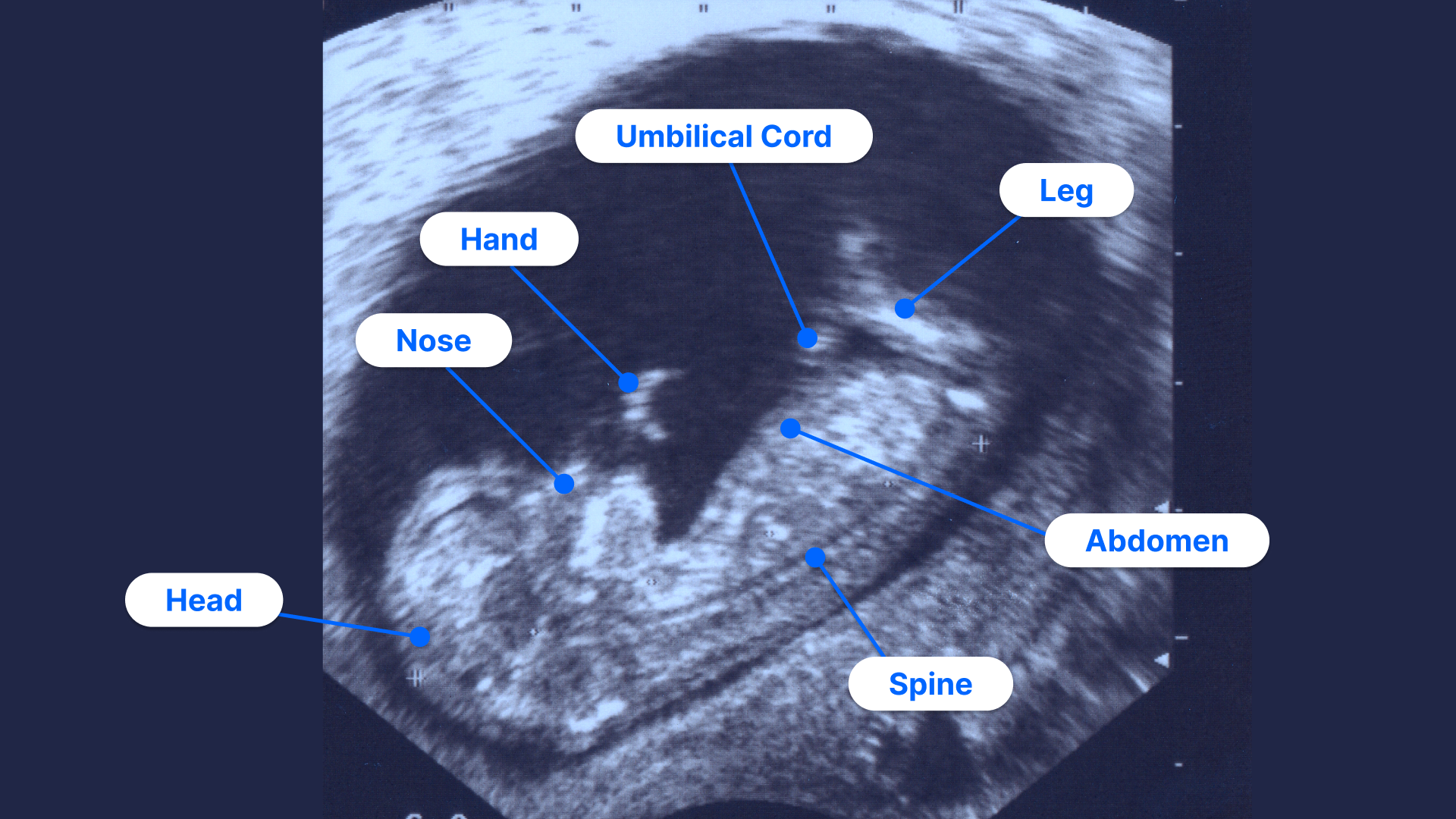 Amniotic Fluid Index