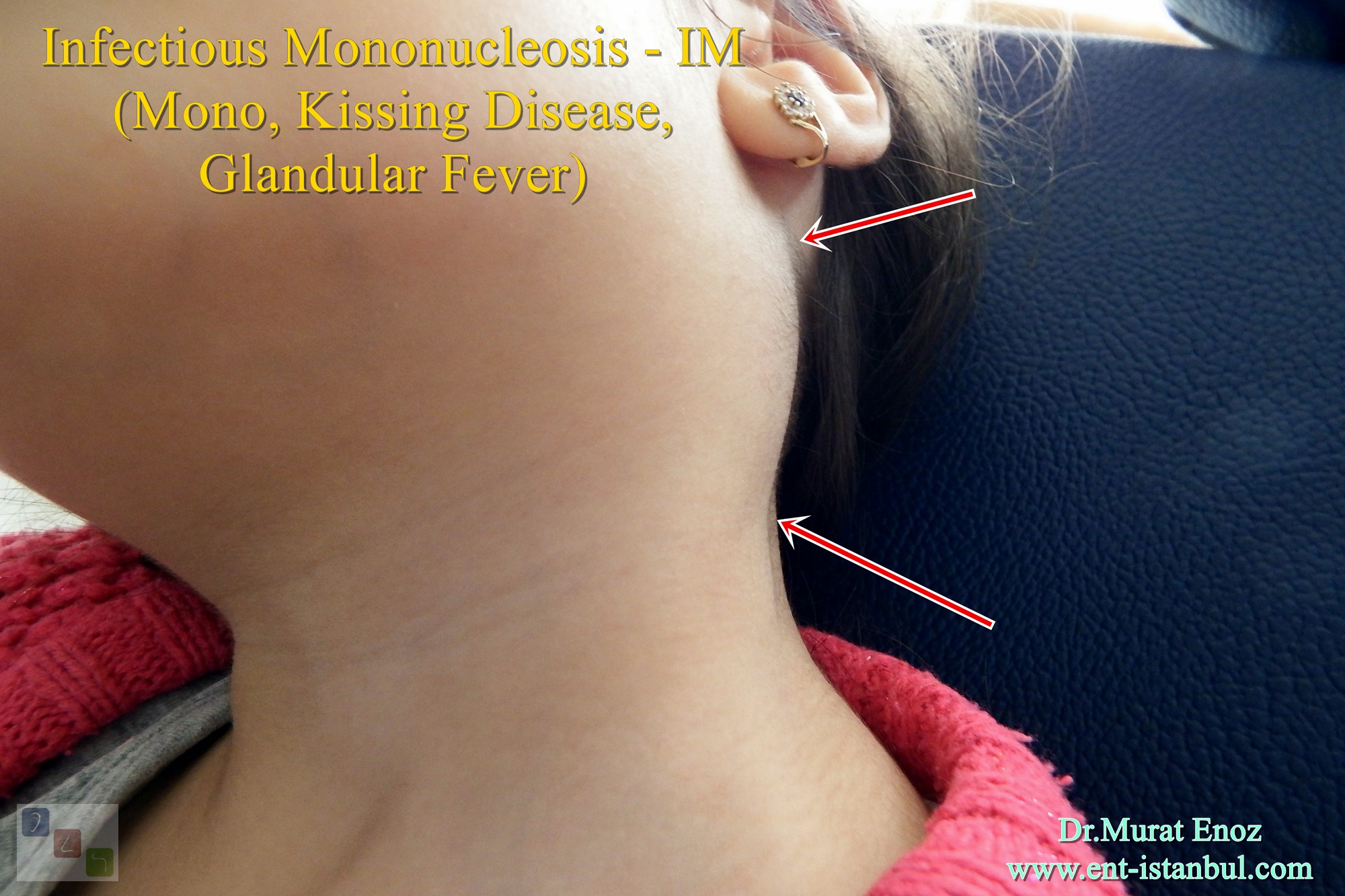 Amoxicillin Dosage By Weight