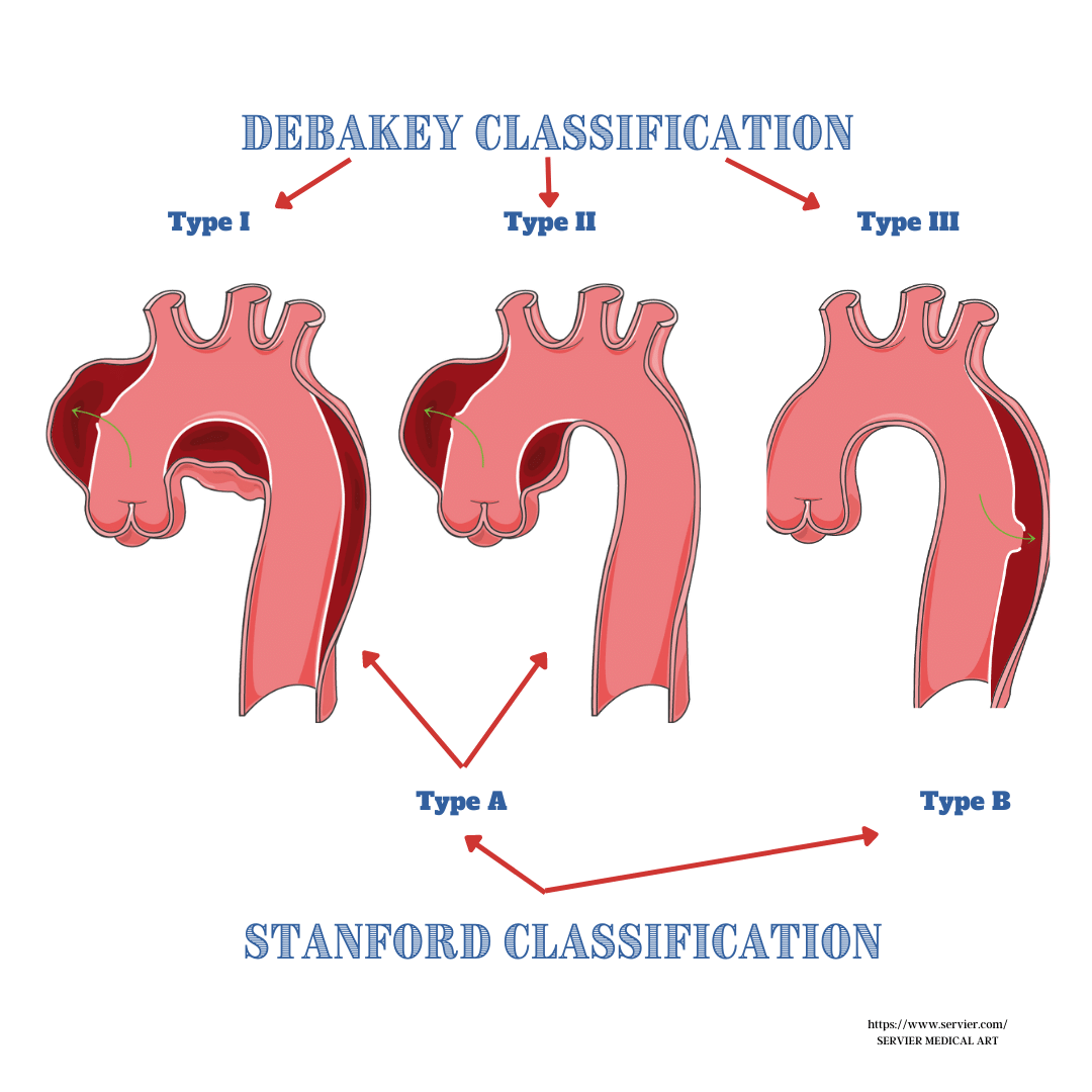 Aneurysm Operation Brain