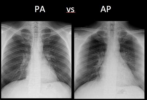 Ap Vs Pa Chest Xray