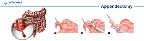 Appendectomy Surgery How Long