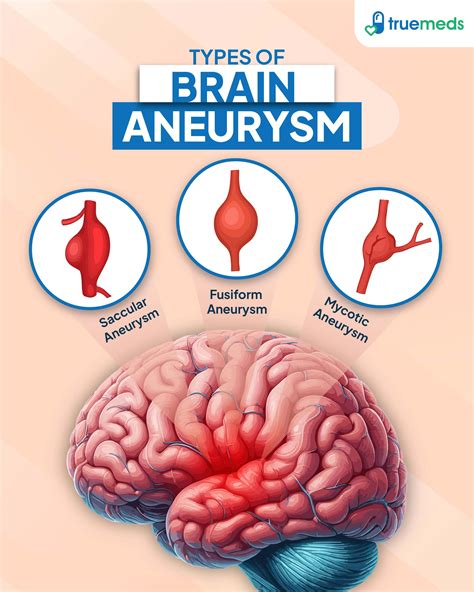 Are Brain Aneurysms Hereditary