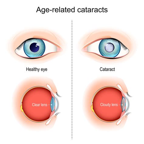 Are Cataracts Hereditary