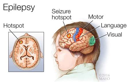 Are Seizures Hereditary