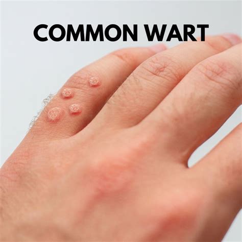 Are Warts Contagious On Hands