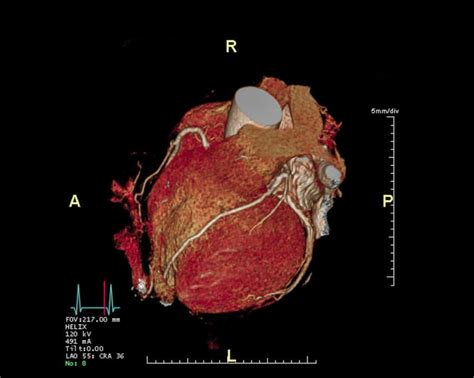 Ascension Health Heart Scan