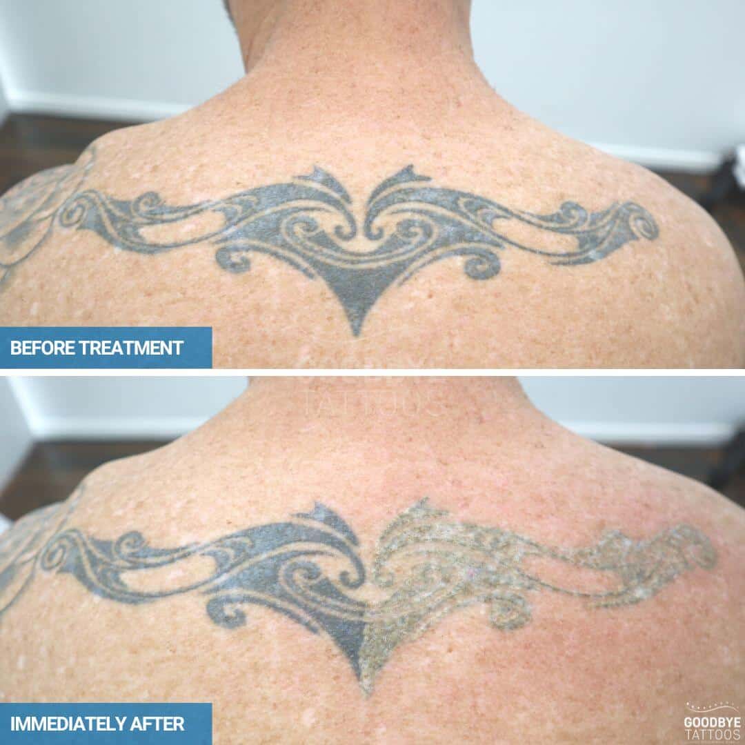 Finding The Best Method For Tattoo Removal