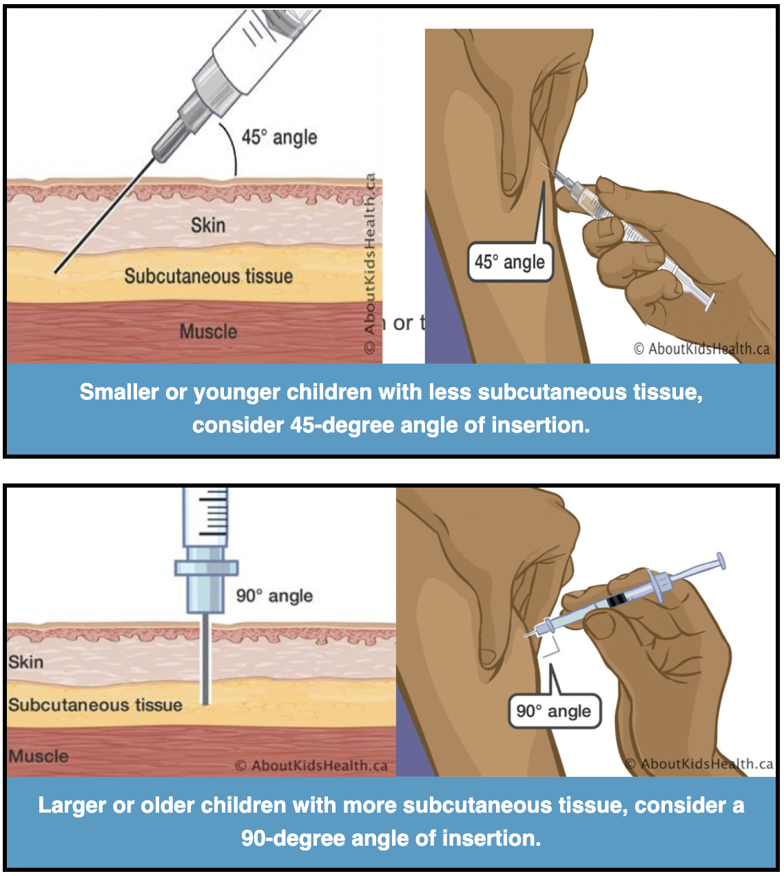 The Best Practice For Subcutaneous Injections To Prevent Complications