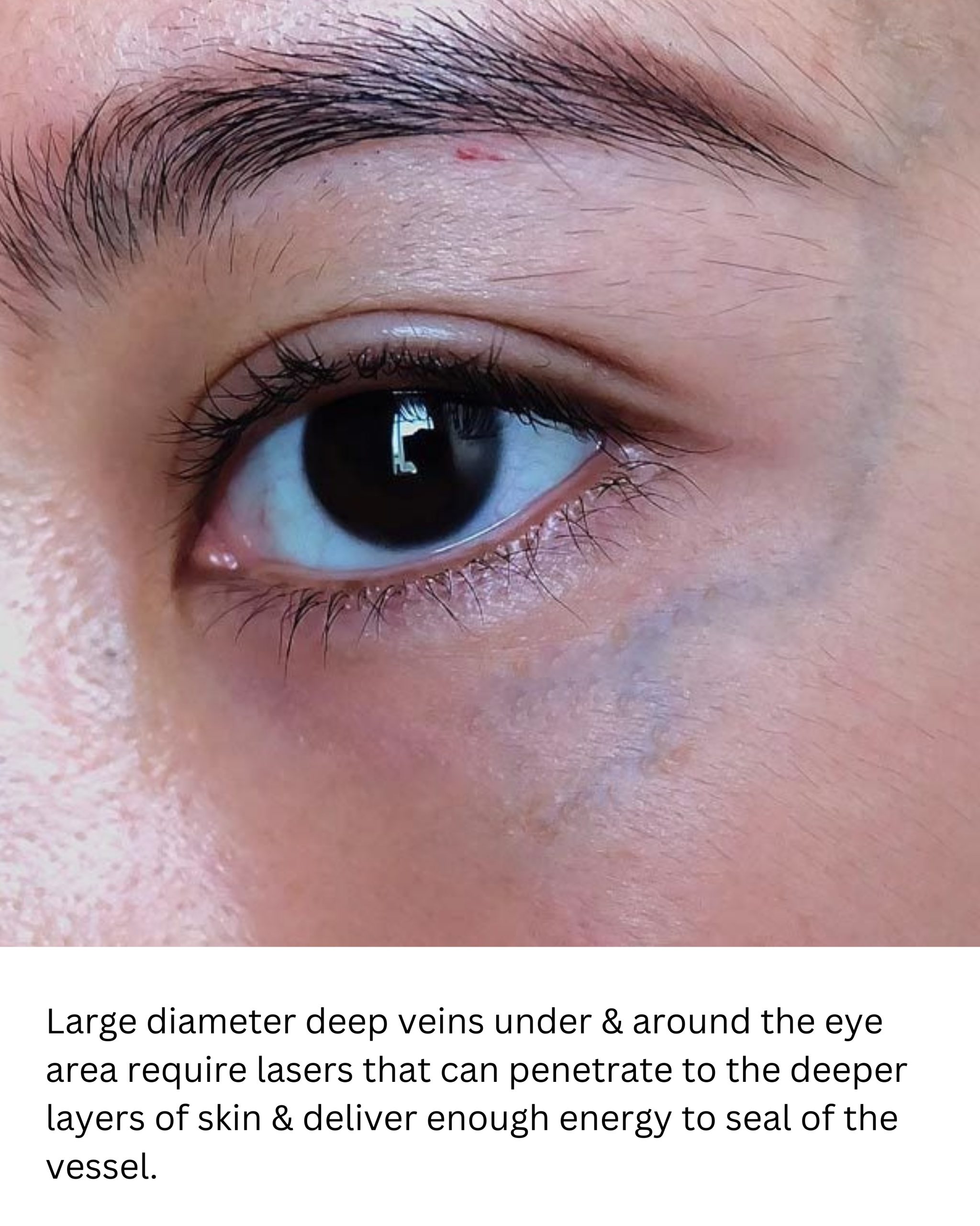 Bulging Tympanic Membrane