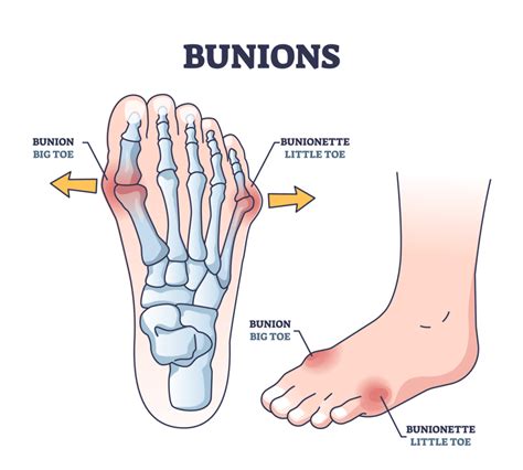 Bunions And Bunionettes
