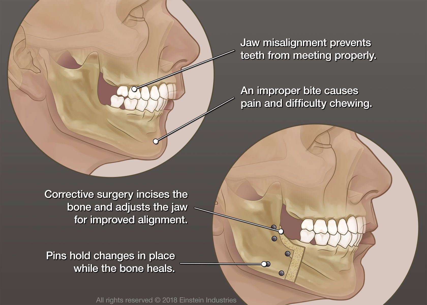 Can A Human Jaw Actually Bite Through Bone