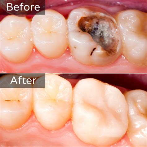 Cavity Prevention Before and After: Real Smile Transformations Revealed