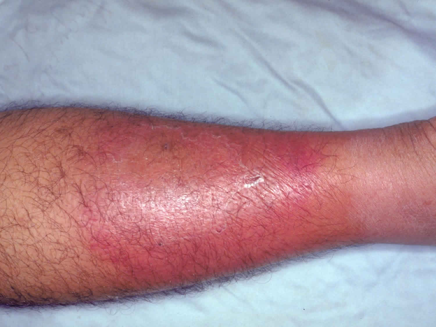 Cellulite On Stomach