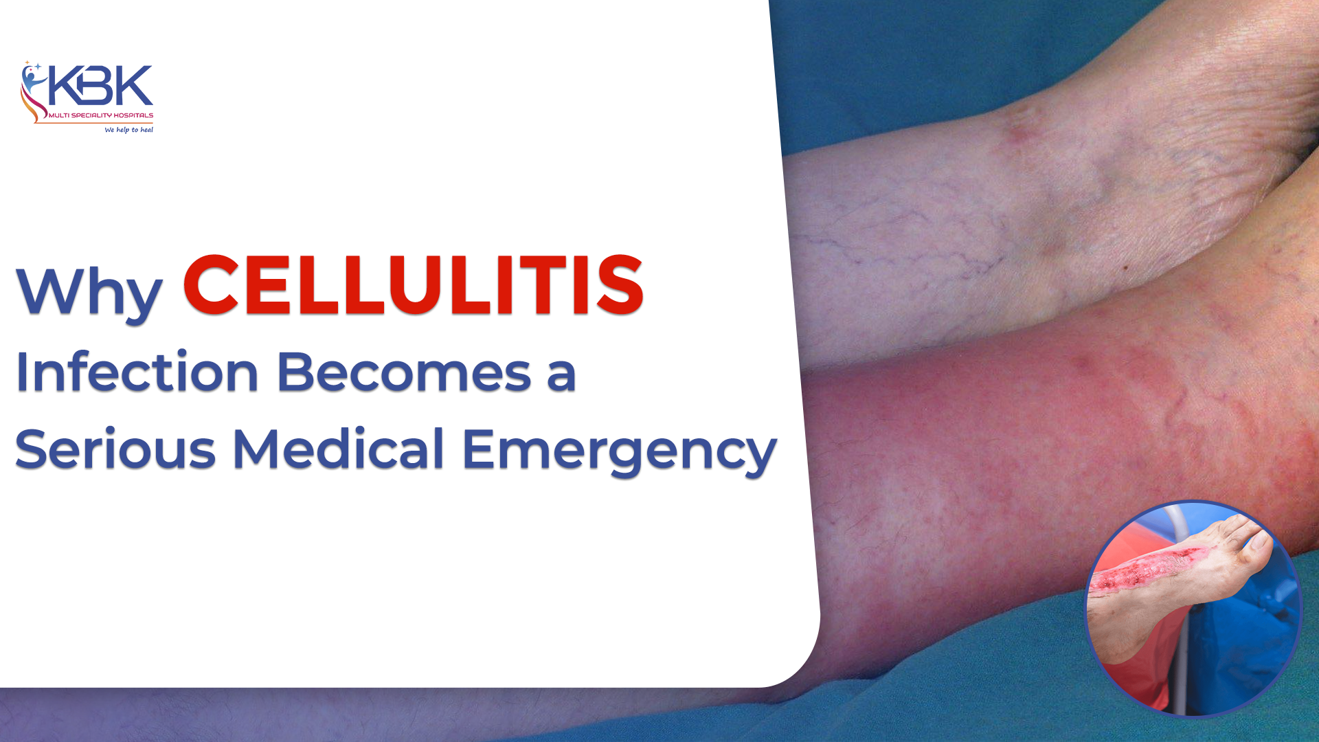 Cellulitis On The Eye