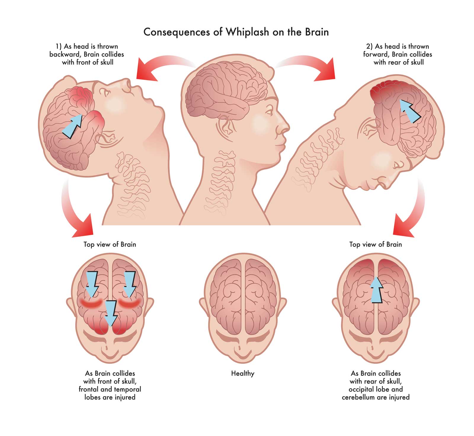 Cervicogenic Headache Physical Therapy