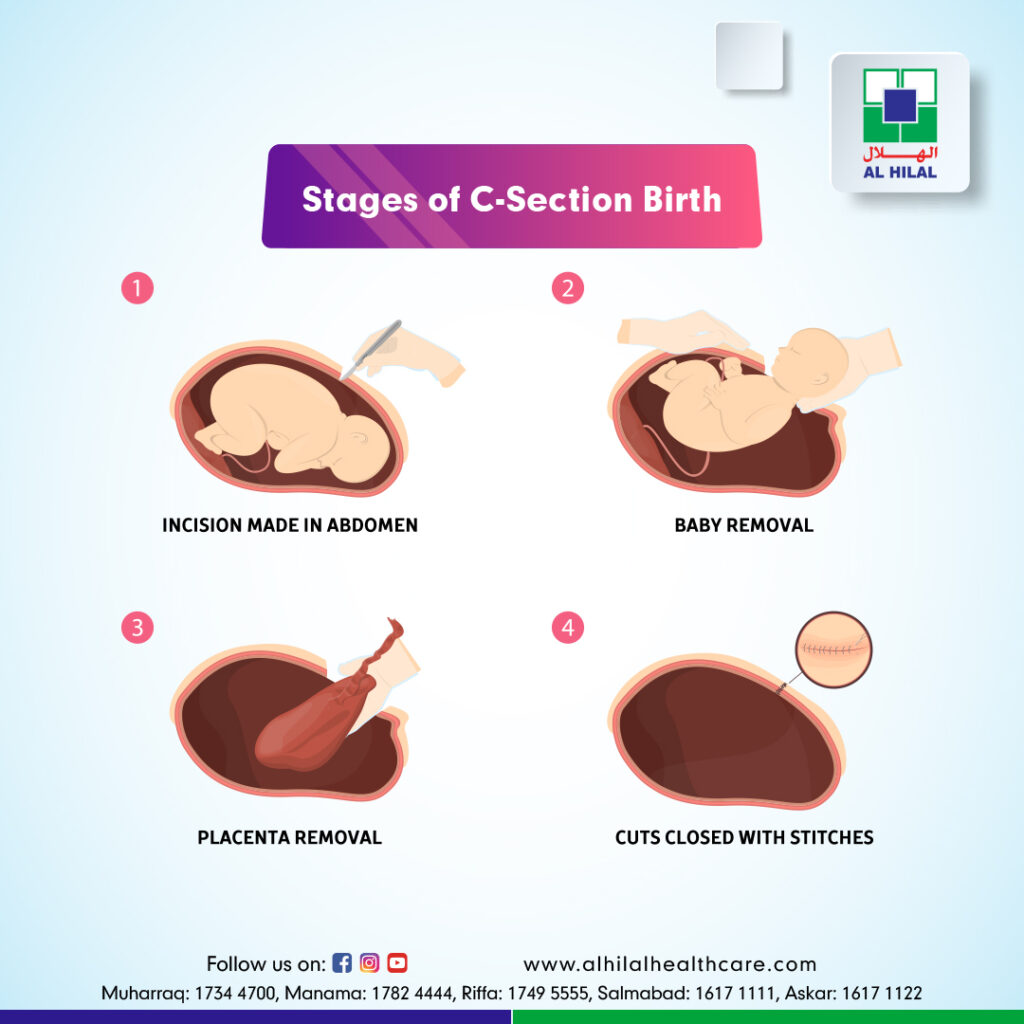 Cesarean Spinal Anesthesia