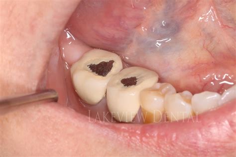 Chipped Tooth Crown