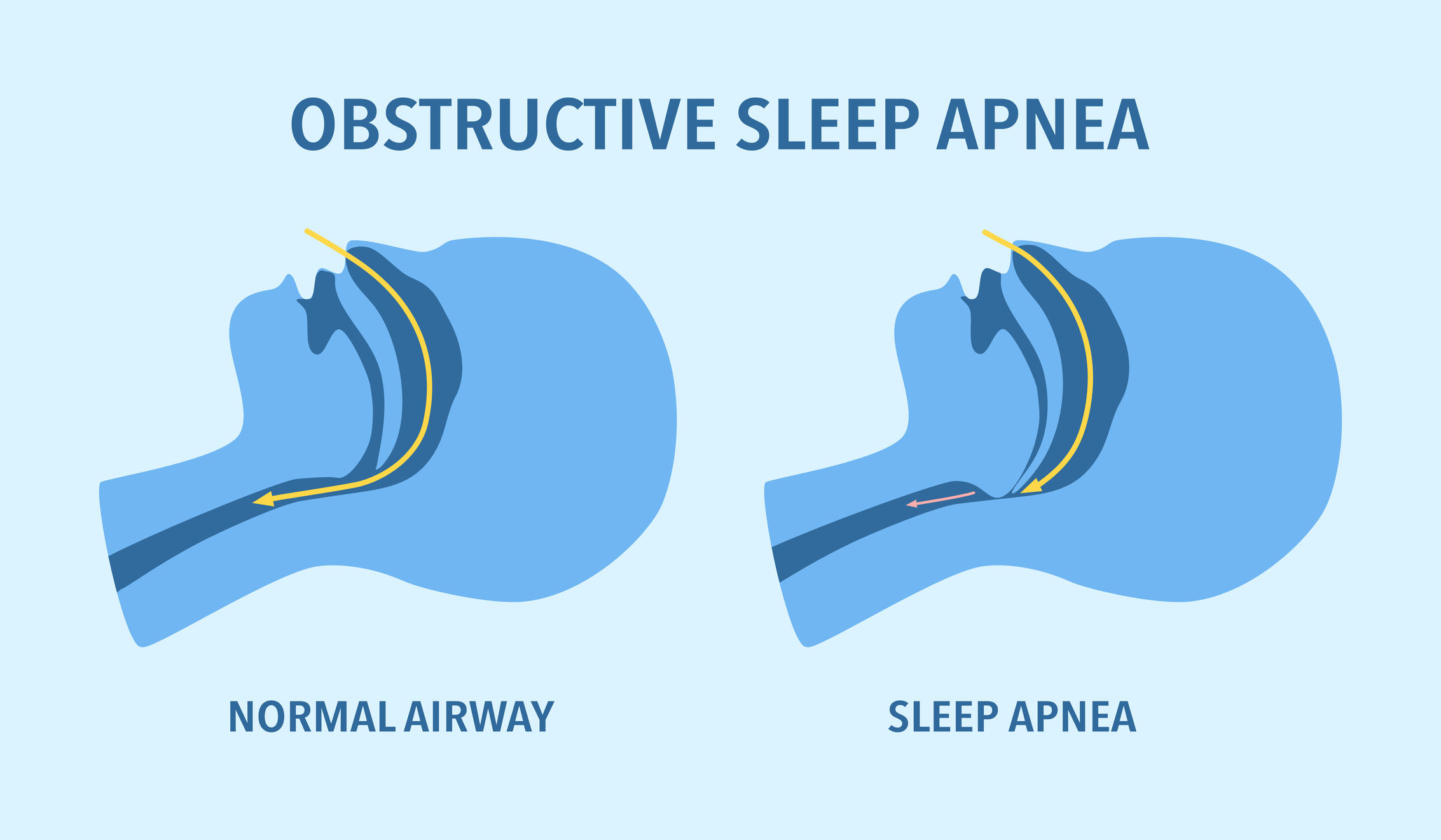 Cpap Pressure Settings