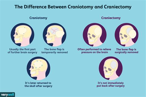Craniectomy Vs Craniotomy