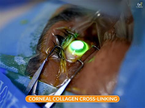 Cross Link Eye Procedure