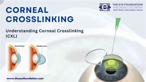 Cross Link Eye