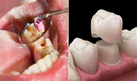 Crowns And Root Canal