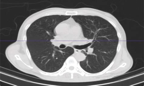 Ct Chest Normal