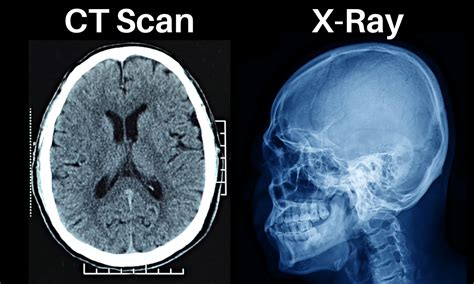 Ct X Ray Difference