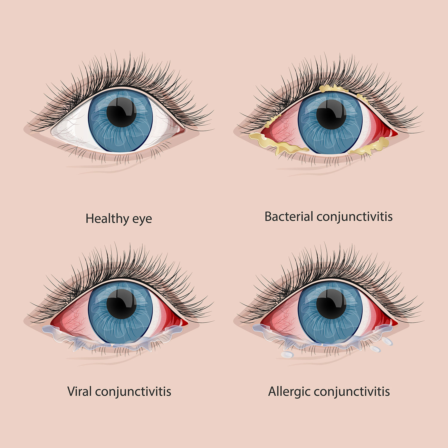 Is Pink Eye Contagious How To Cure It At Home