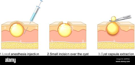 Cyst Cyst Removal