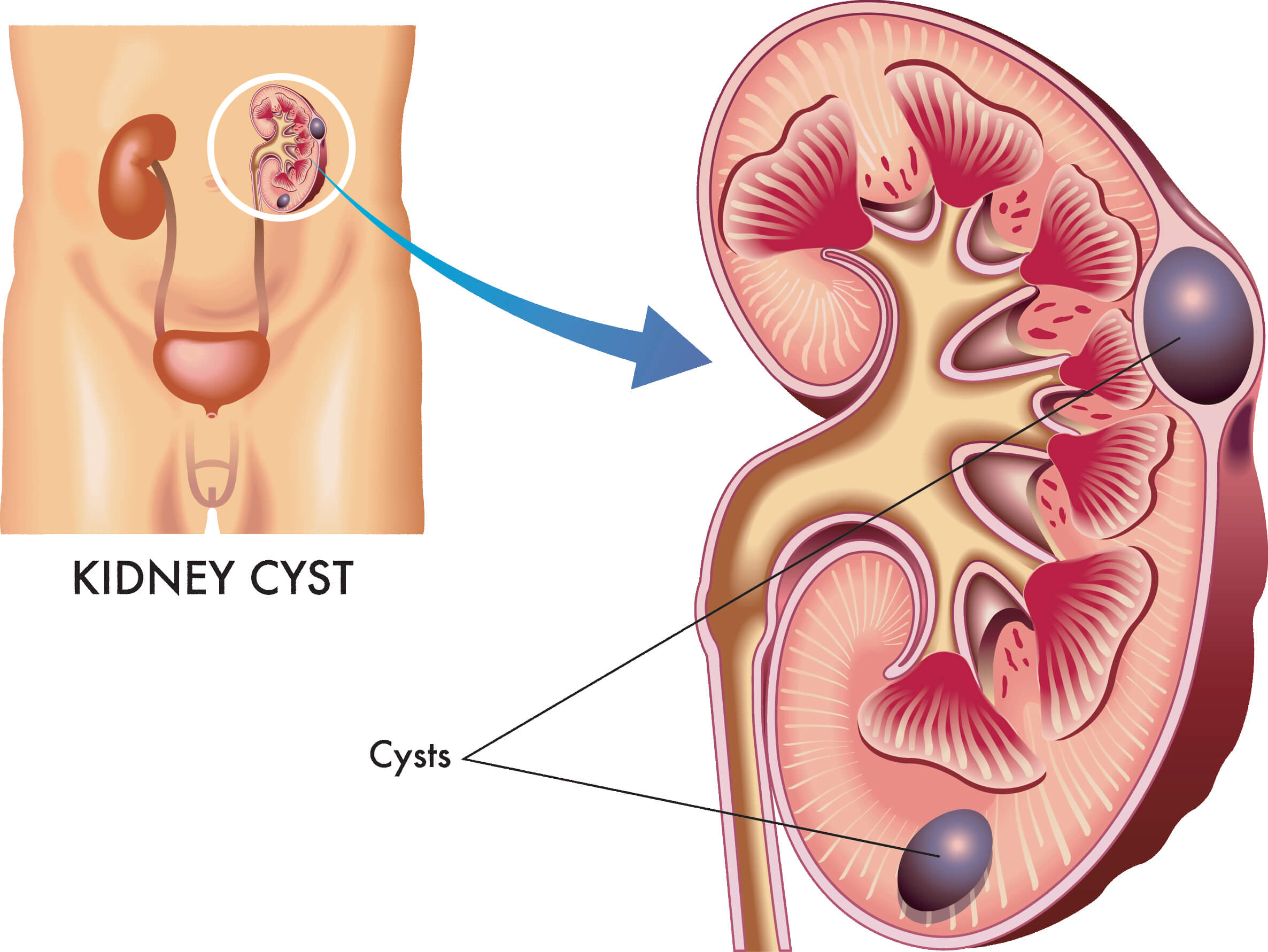 Cysts Or Tumors