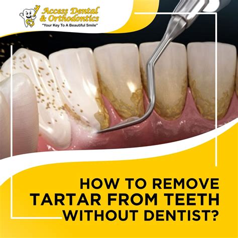 Daily Habits for Effective Tartar Removal Without Dentist Visits