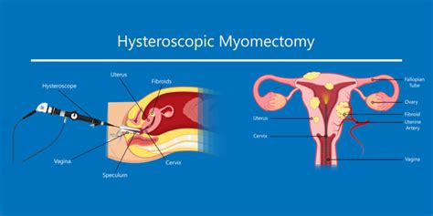 D&C And Hysteroscopy