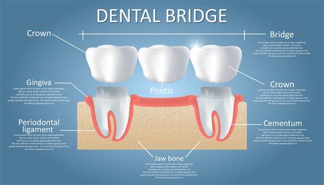 Dental Bridge Treatment Risks Uncovered
