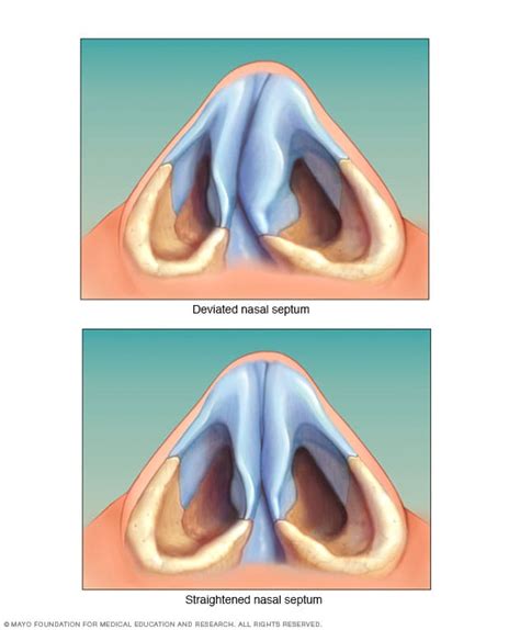 Deviated Septum Symptoms