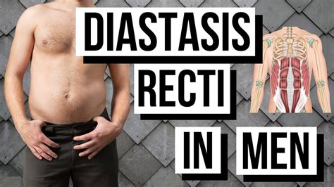 Diastasis Recti Men