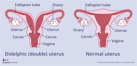 Didelphic Uterus Pictures