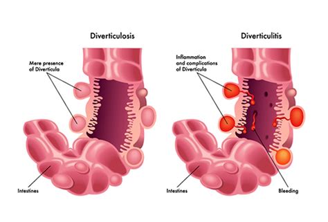 Diverticular Disease Alcohol