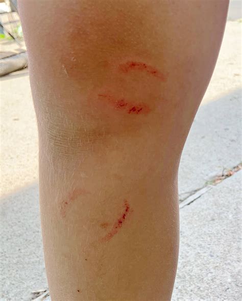 Do Piranha Bites Hurt