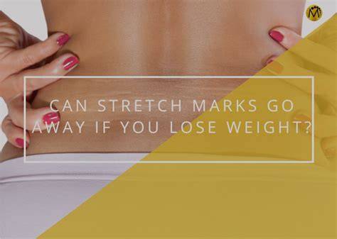 Do Stretch Marks Go Away
