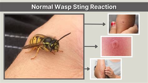 Do You Wasp Sting