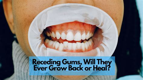 Do Your Gums Grow Back