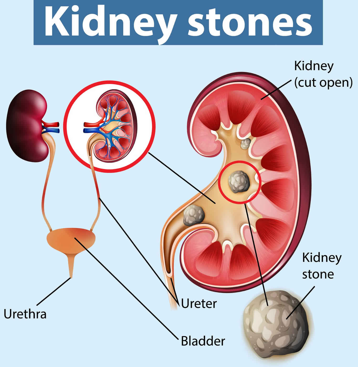Does Age Affect Kidney Stones How Risk Changes With Years