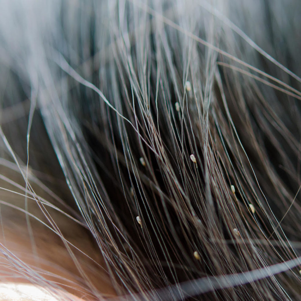 Does Freezing Kill Head Lice: The Truth Revealed
