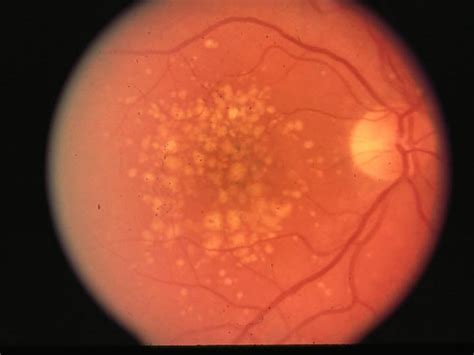 Drusen Eye Disease