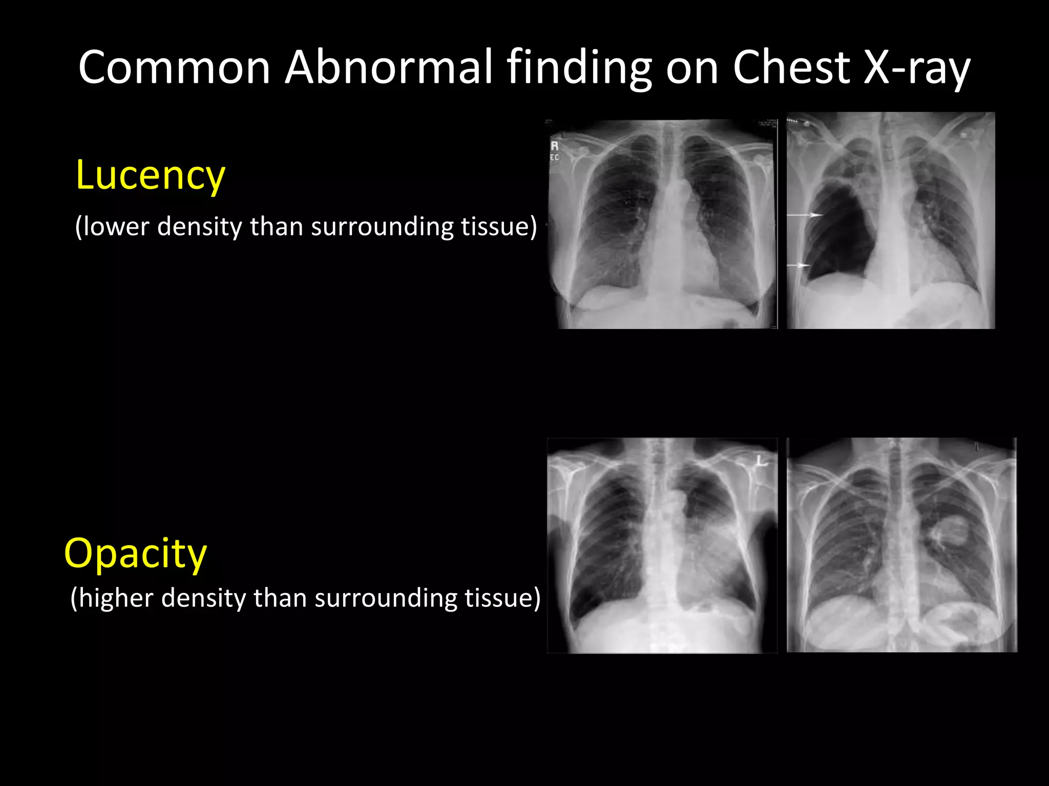 An Example Of A Bad Chest Xray What Not To Miss